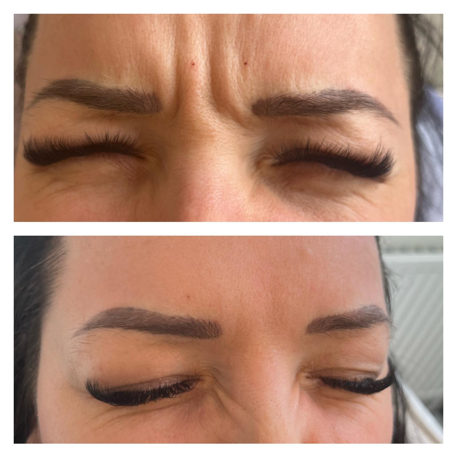 Anti wrinkle treatment result