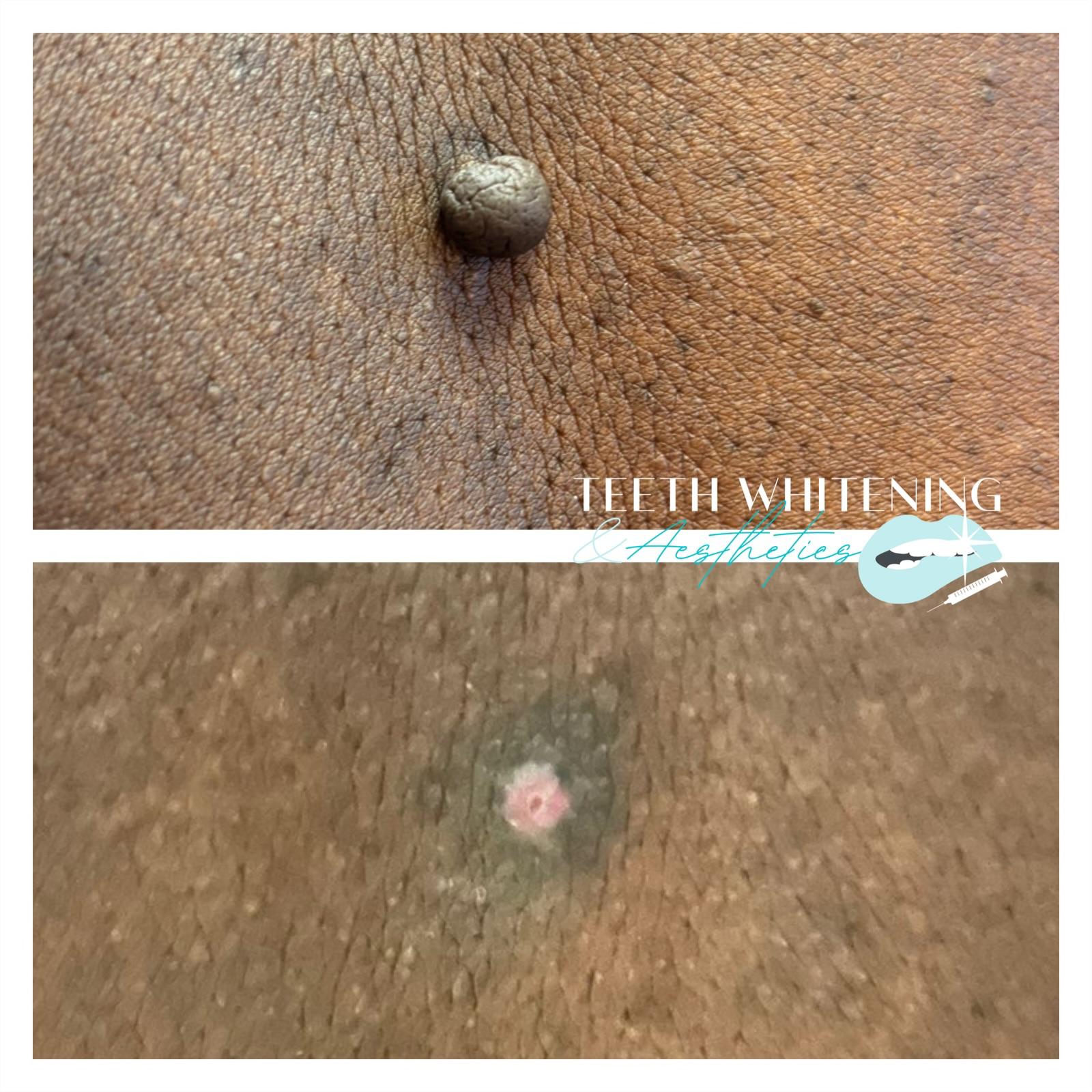 Cryotherapy skin tag removal result