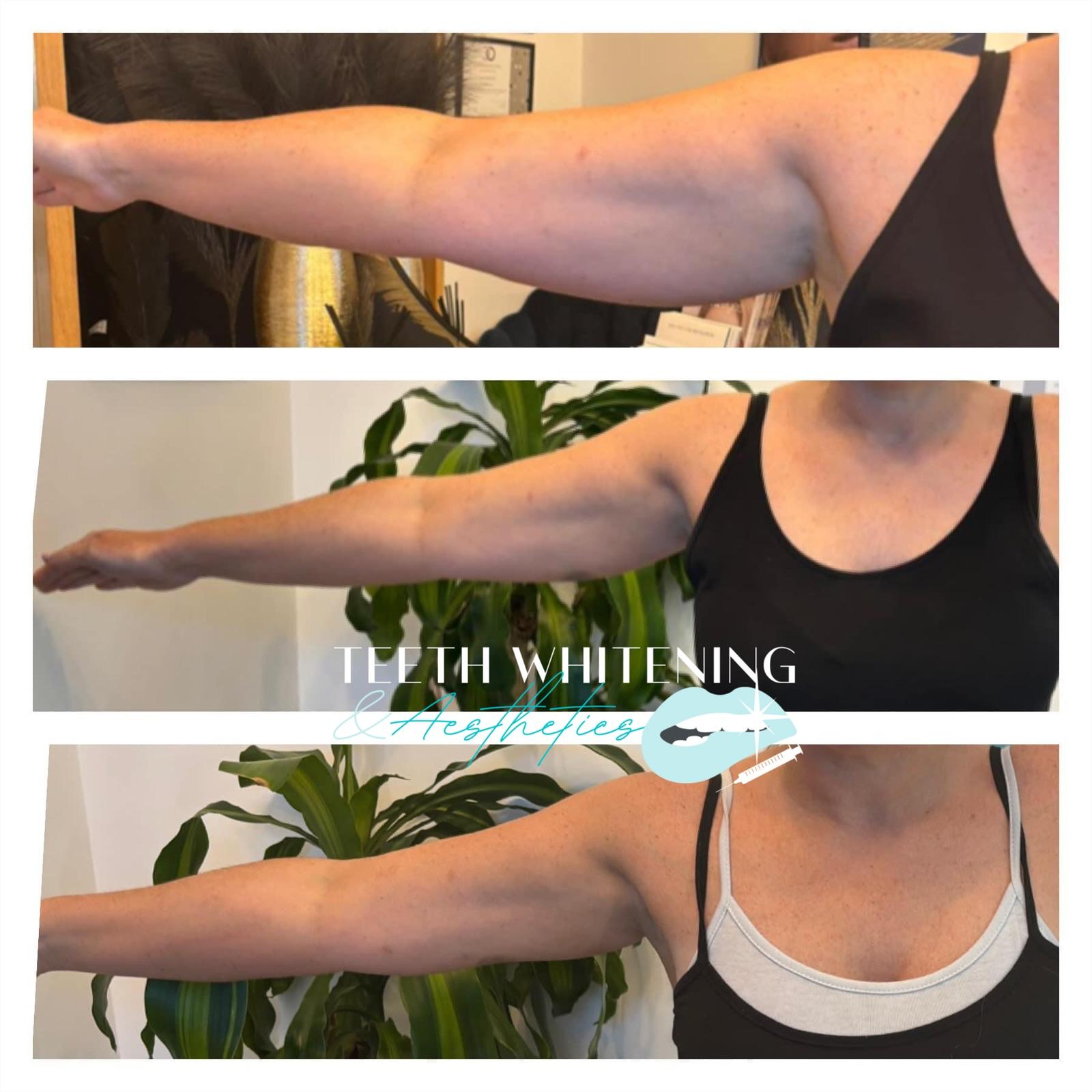 Fat dissolving injections result