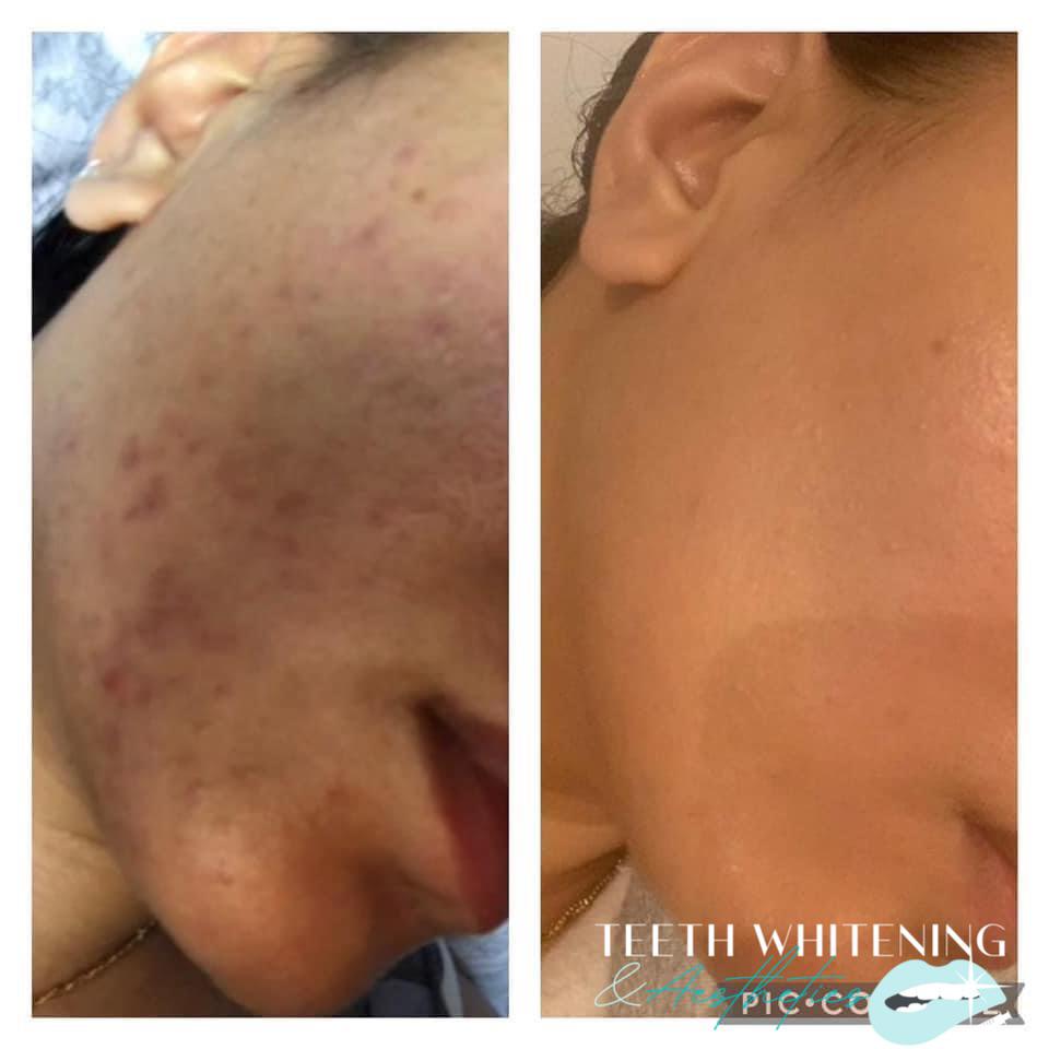 Microdermabrasion treatment