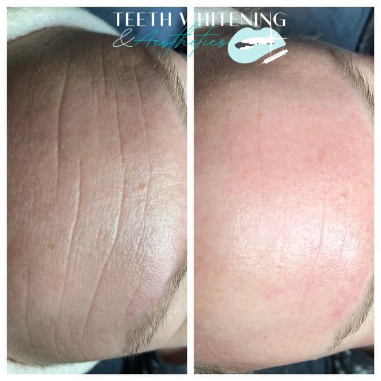 Microneedling treatment