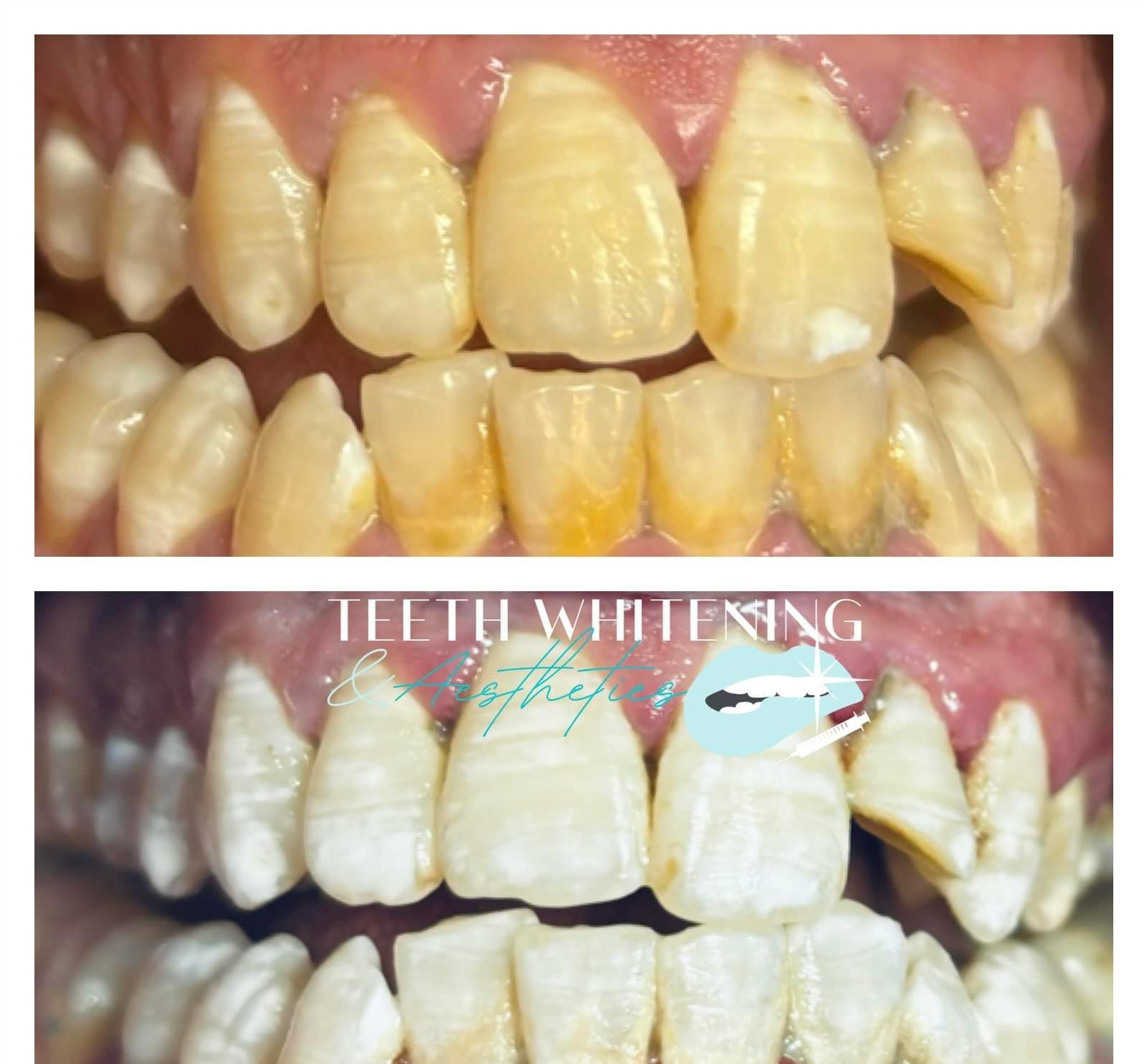 Teeth Whitening Treatment