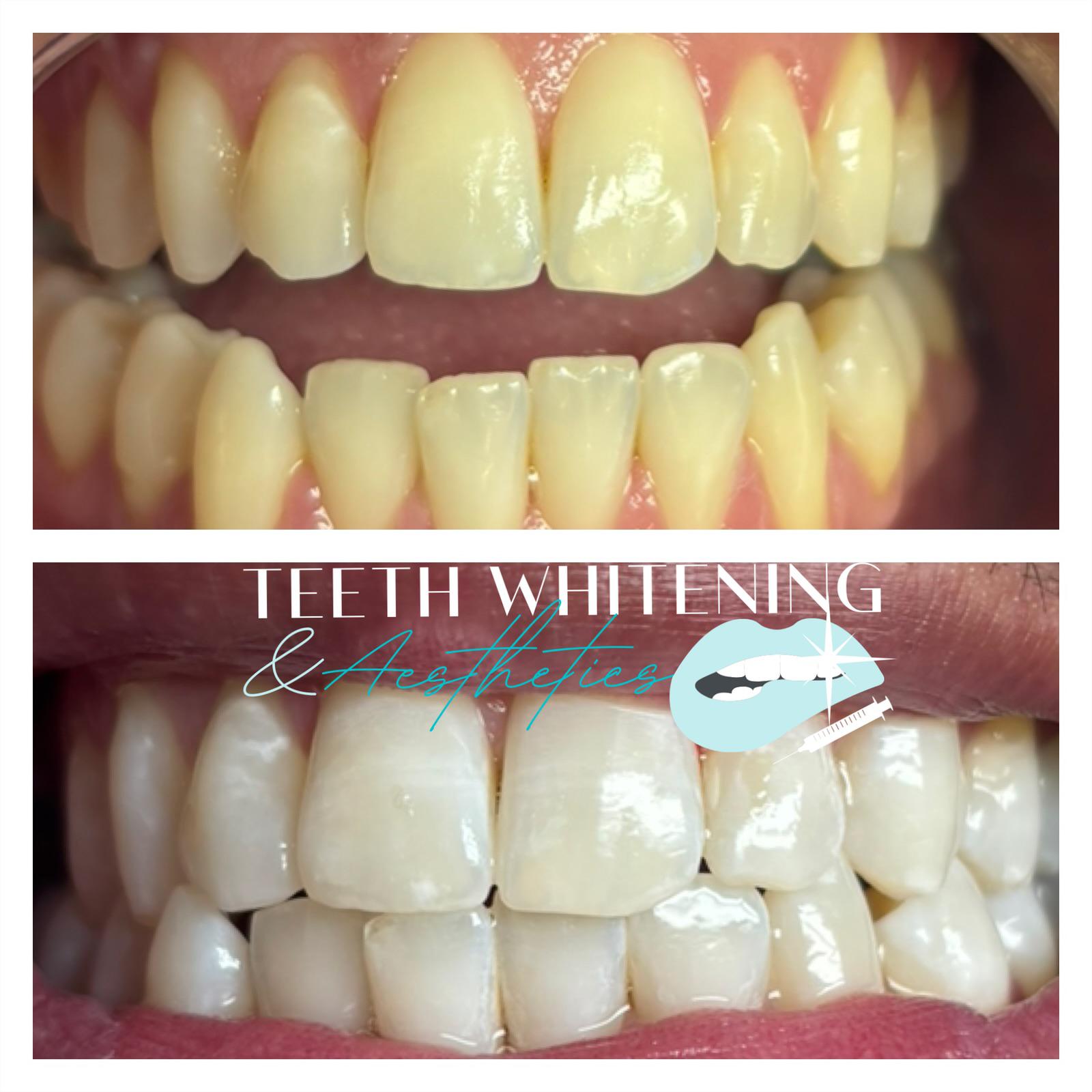 Teeth whitening before and after result